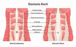 Does Diastasis Recti Affect Labor?