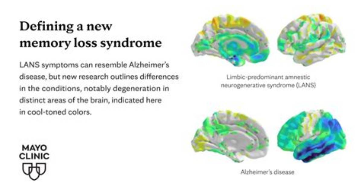 Does Dilantin Cause Memory Loss?