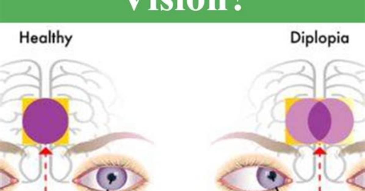 Does Diplopia Go Away?