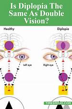 Does Diplopia Go Away?