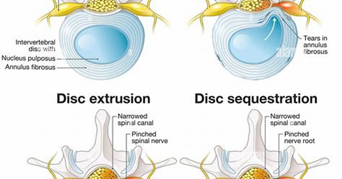 Does Disc Protrusion Need Surgery?