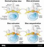 Does Disc Protrusion Need Surgery?