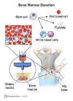 Does Donating Bone Marrow Hurt?