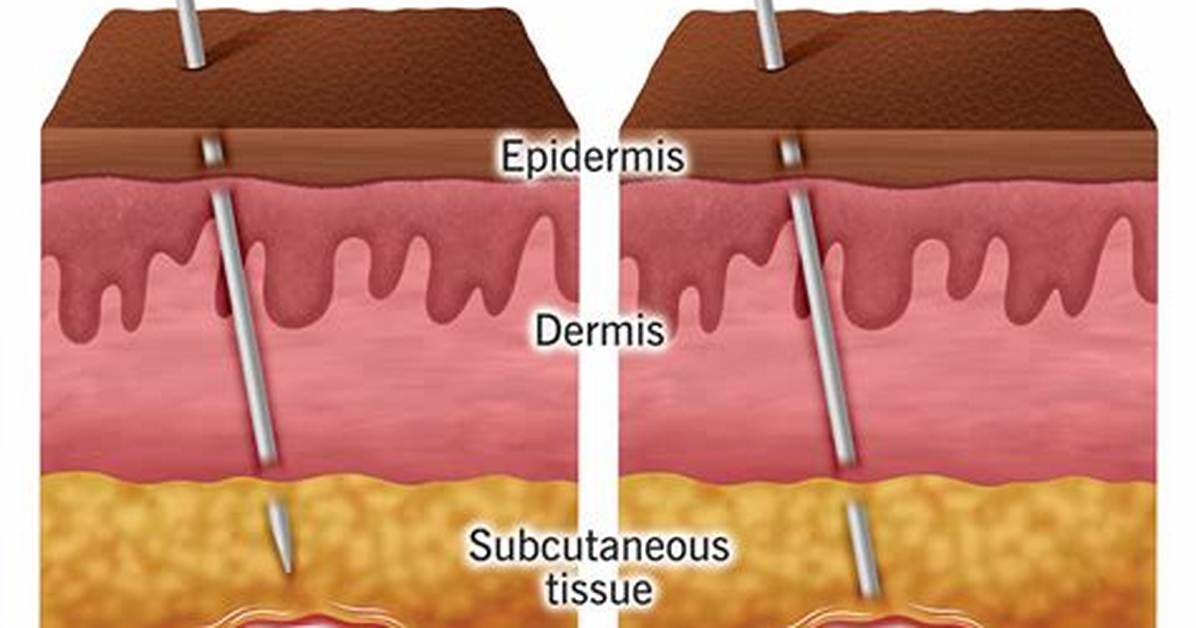 Does Dry Needling Work?