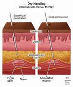 Does Dry Needling Work?