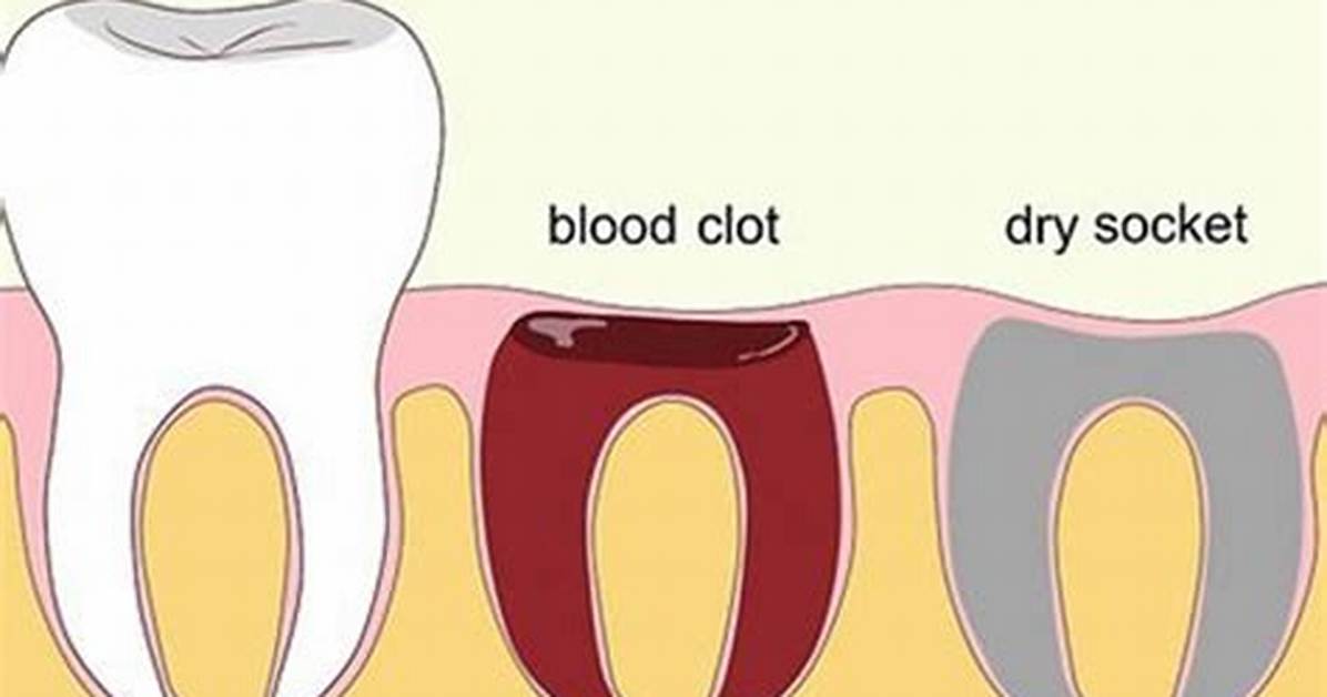 Does Dry Socket Hurt?