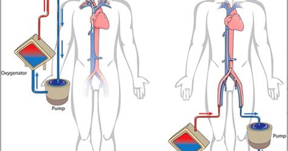 Does Ecmo Work for Covid?