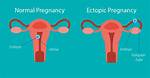Does Ectopic Pregnancy Survive?