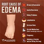 Does Edema Hurt