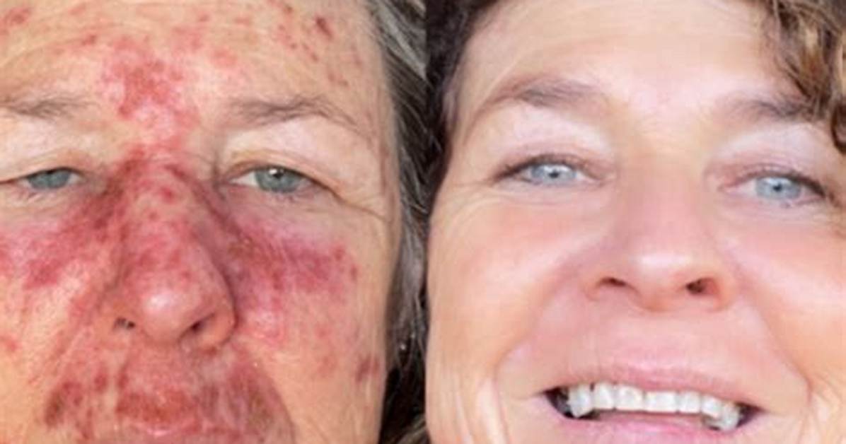 Does Efudex Affect Normal Skin?