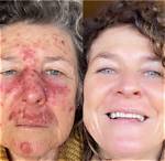 Does Efudex Affect Normal Skin?