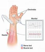 Does Electromyography Test Hurt?