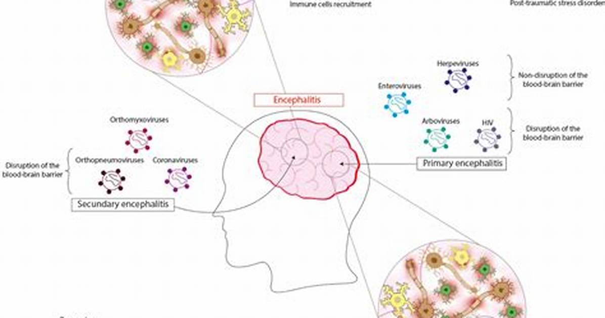 Does Encephalitis Cause Seizures?