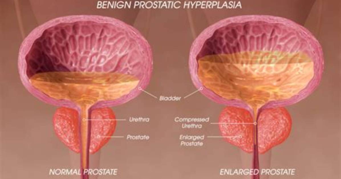 Does Enlarged Prostate Affect Sperm Count?