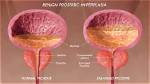 Does Enlarged Prostate Affect Sperm Count?