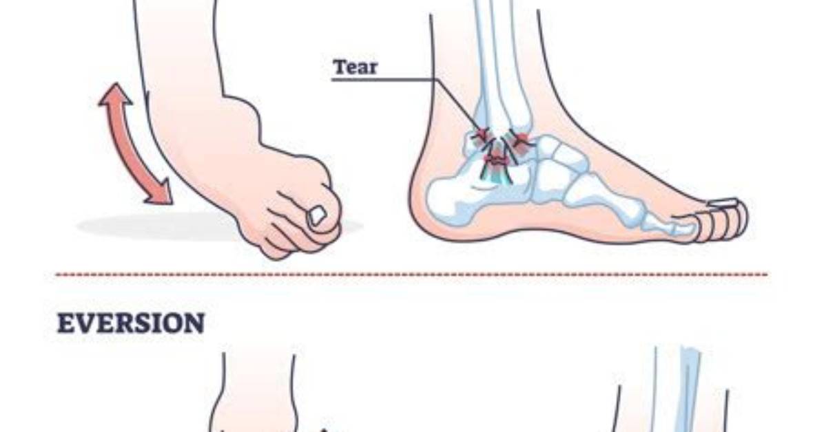 Does Eversion Cause Ankle Sprains?