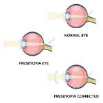 Does Everyone Get Presbyopia? | Contextresponse. Com