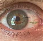 Does Everyone Have Limbal?
