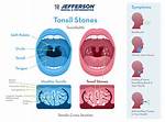 Does Everyone Have Tonsilloliths?
