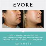 Does Evoke by Inmode Work?