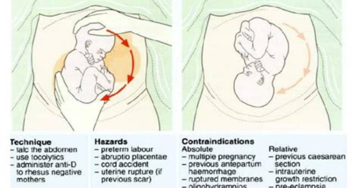 Does External Cephalic Version Hurt?