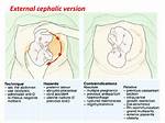 Does External Cephalic Version Hurt?