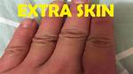 Does Extra Skin Go Away?