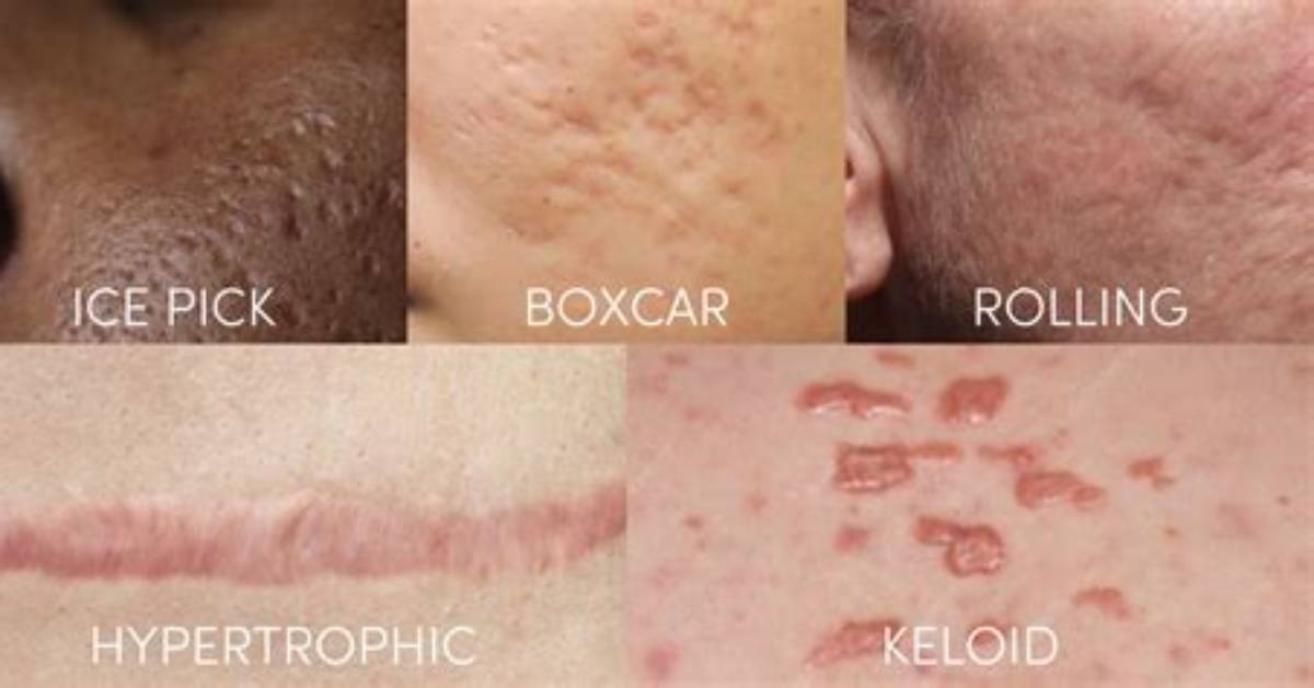Does Extraction Cause Scarring?