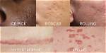 Does Extraction Cause Scarring?