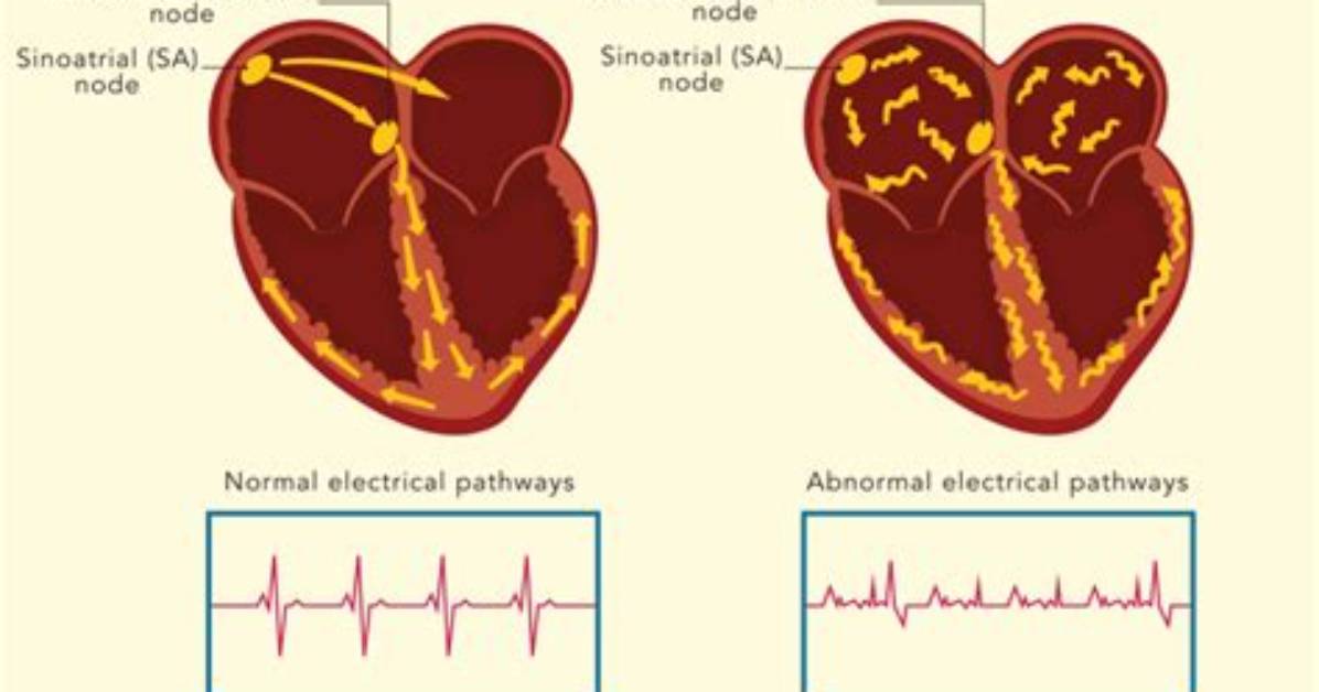 Does Fibrillation Affect the Brain?