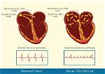 Does Fibrillation Affect the Brain?