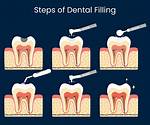 Does Fillings Require Anesthesia?