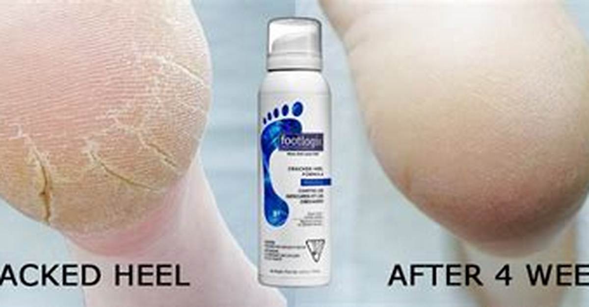 Does Footlogix Really Work?
