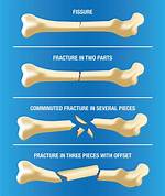 Does Fracturing a Bone Hurt?