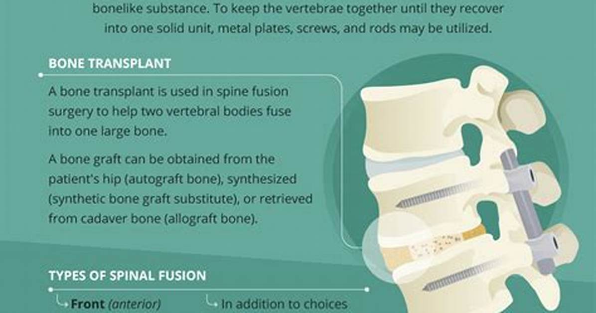 Does Fusing Vertebrae Work?