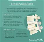 Does Fusing Vertebrae Work?