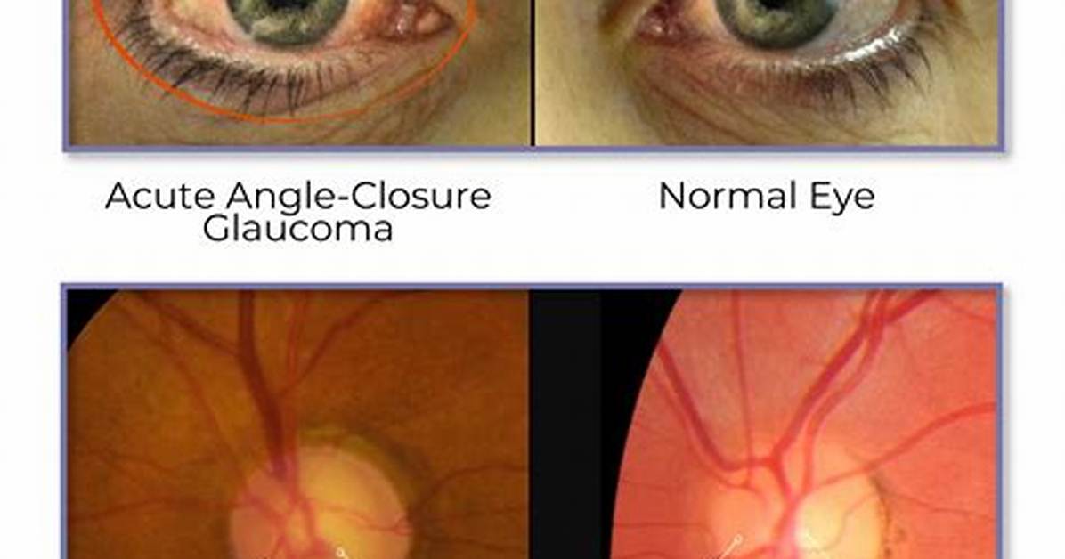 Does Glaucoma Progress Slowly?