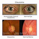 Does Glaucoma Progress Slowly?
