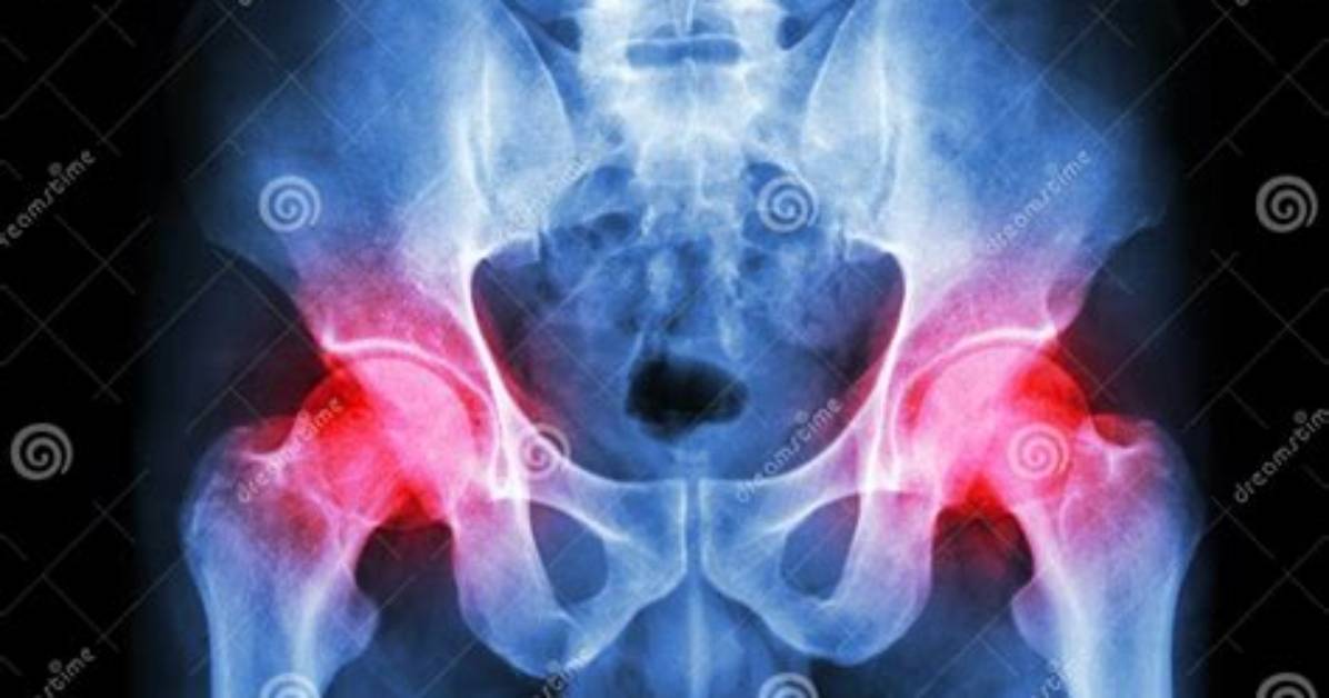 Does Gout Affect the Hip?