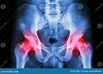 Does Gout Affect the Hip?