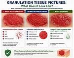 Does Granulation Tissue Hurt?