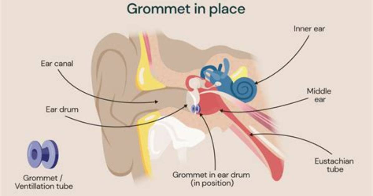 Does Grommet Affect Hearing?