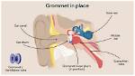 Does Grommet Affect Hearing?