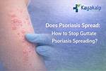 Does Guttate Psoriasis Spread?