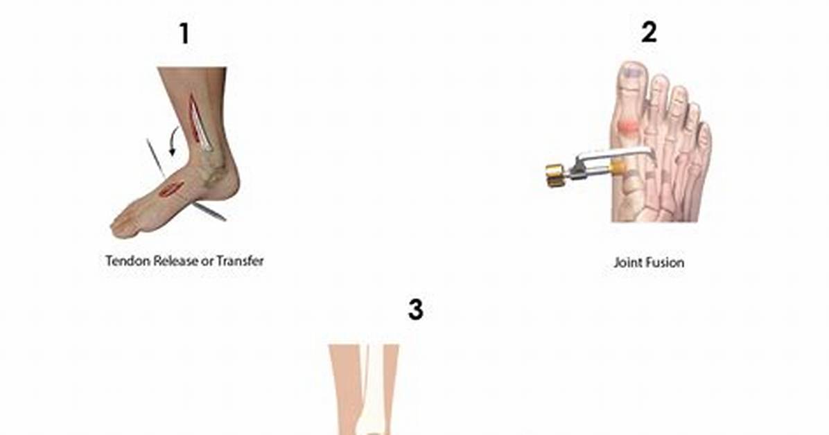 Does Hammertoe Surgery Hurt?