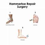 Does Hammertoe Surgery Hurt?