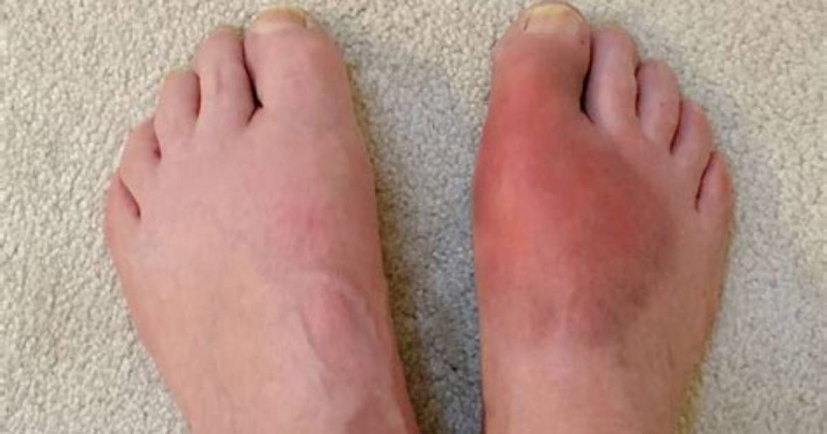 Does Heat Affect Gout