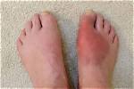 Does Heat Affect Gout