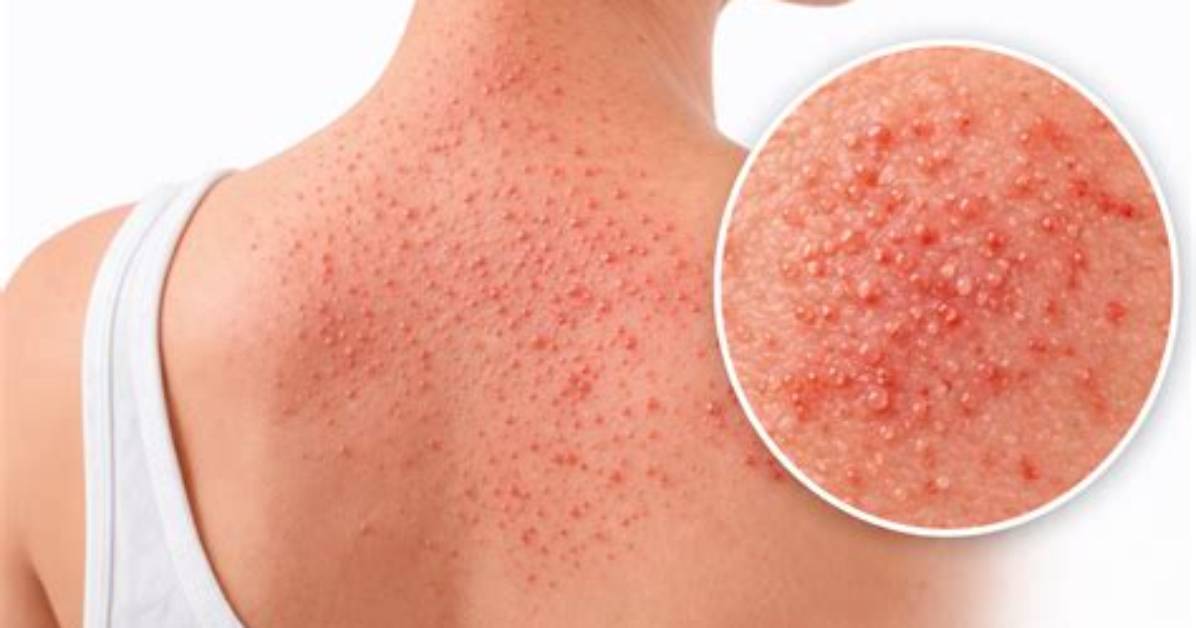 Does Heat Rash Spread?