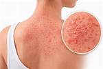 Does Heat Rash Spread?